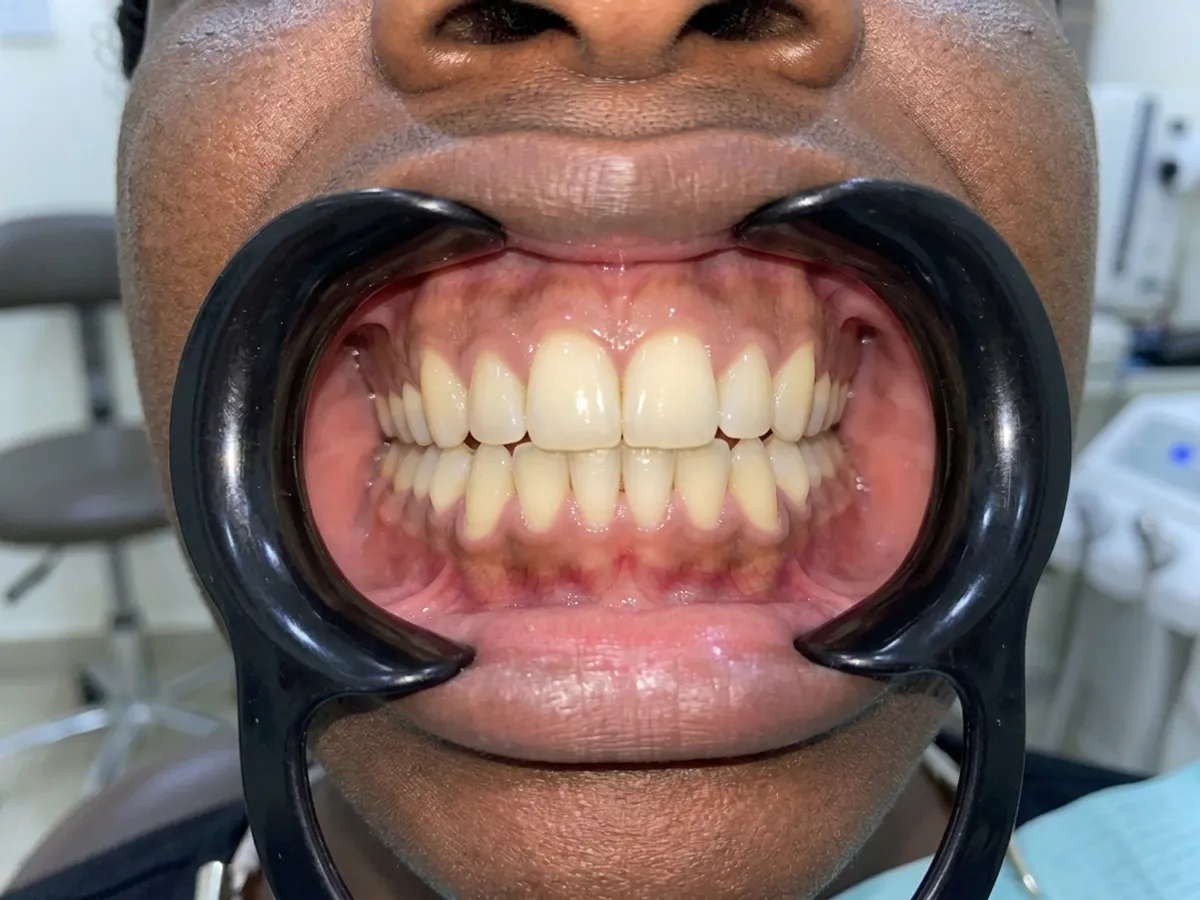 Braces & aligners, after