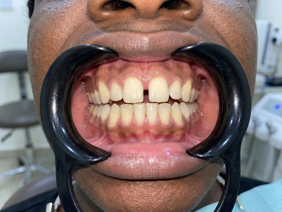 Braces & aligners, before